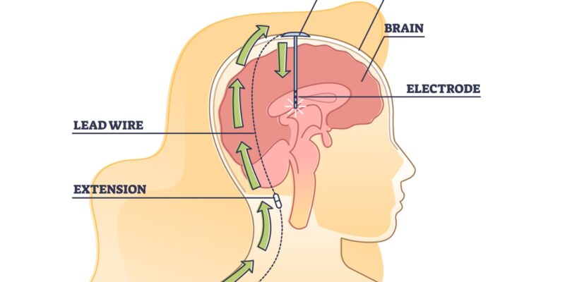 OCS,Diepe Hersenstimulatie